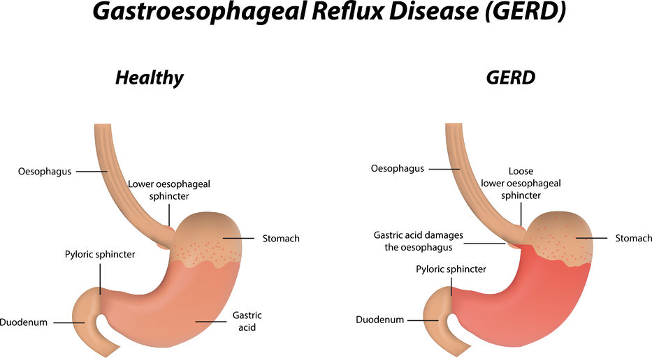GASTROESOPHAGEAL REFLUX DISEASE (GERD) - A NATUROPATHIC APPROACH